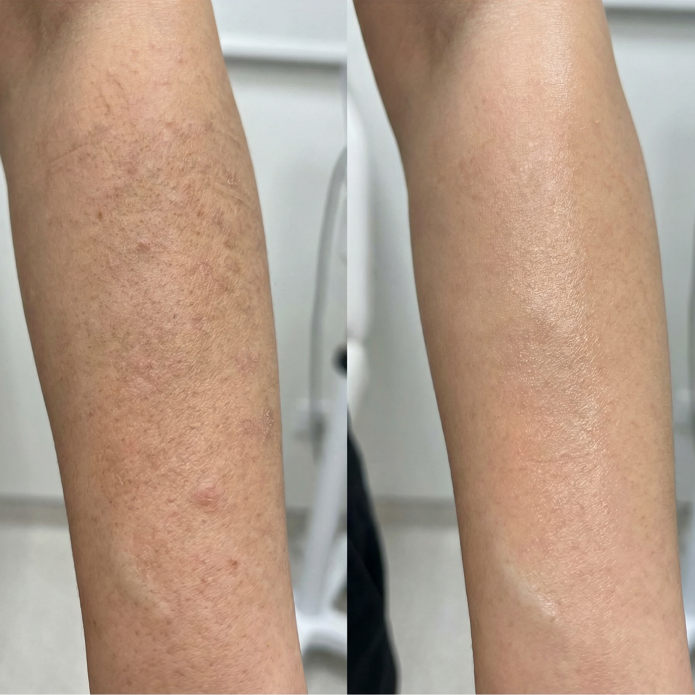 Before and after comparison of a person's leg with visible skin texture changes.
